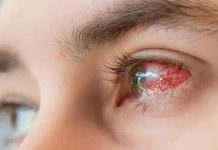Conjunctivitis Outbreak Hits Epidemic Levels in Makran Region