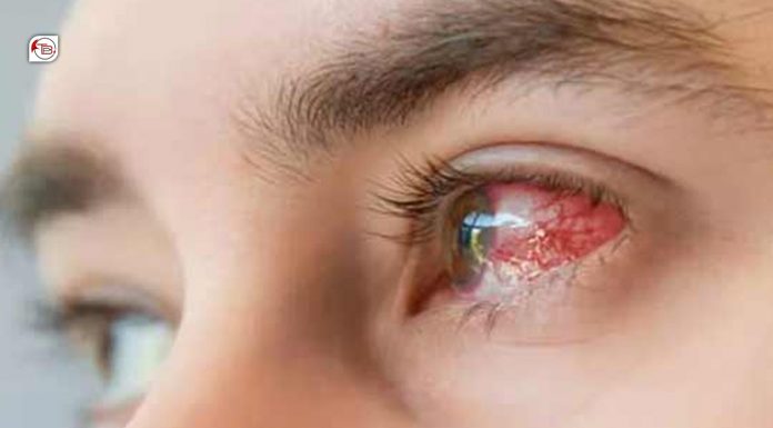 Conjunctivitis Outbreak Hits Epidemic Levels in Makran Region