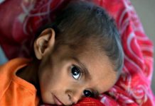 49.6% of Children in Balochistan Affected by Malnutrition — Report