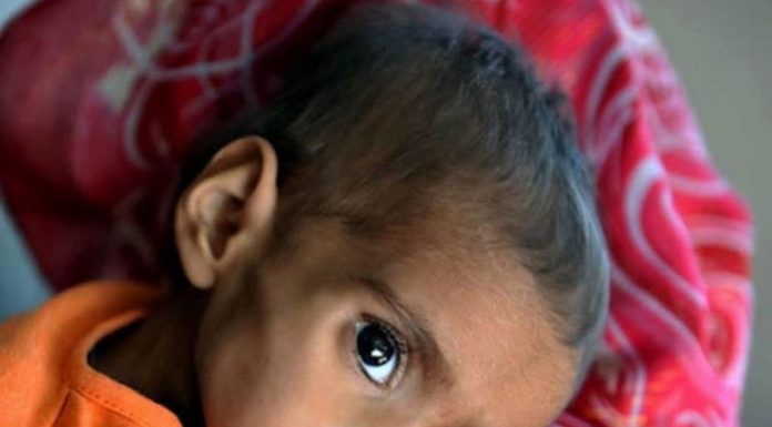 49.6% of Children in Balochistan Affected by Malnutrition — Report