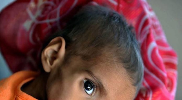 Severe Child Malnutrition Crisis Deepens in Balochistan Amid Poverty and Lack of Basic Services